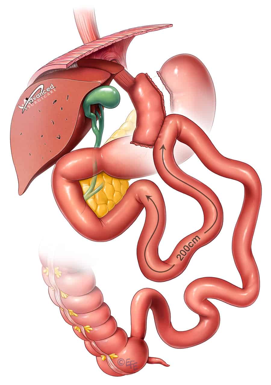 single anastomosis gastric bypass